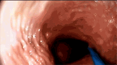 Camera inside the vagina during