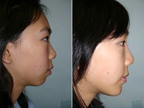 Bourbon recommend best of dr Gallery rhinoplasty 2019 Pics Asian