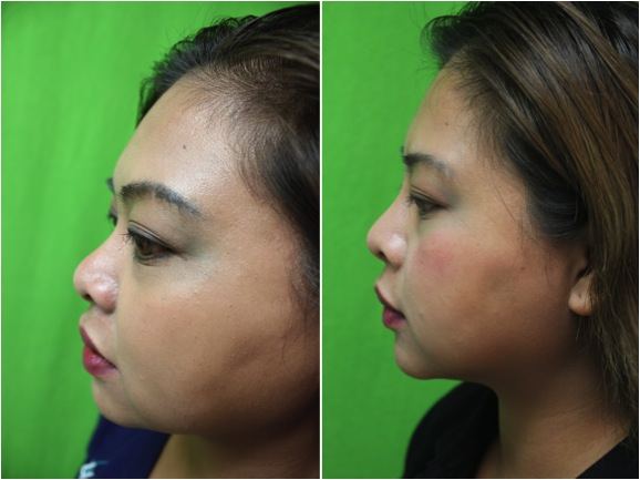 best of Rhinoplasty Gallery Pics Asian 2019 dr