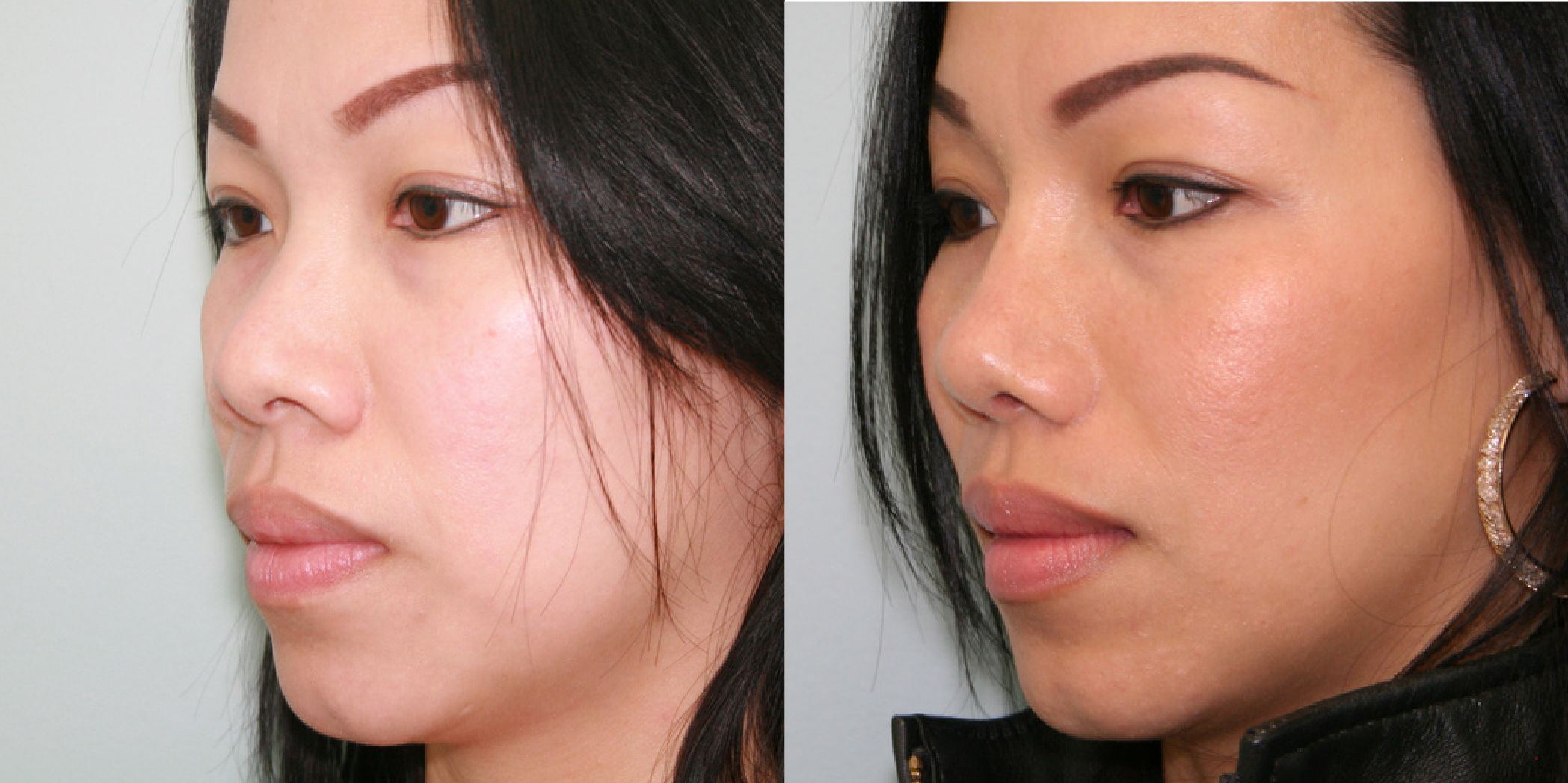 Buzz reccomend Asian rhinoplasty dr Pics Gallery 2019